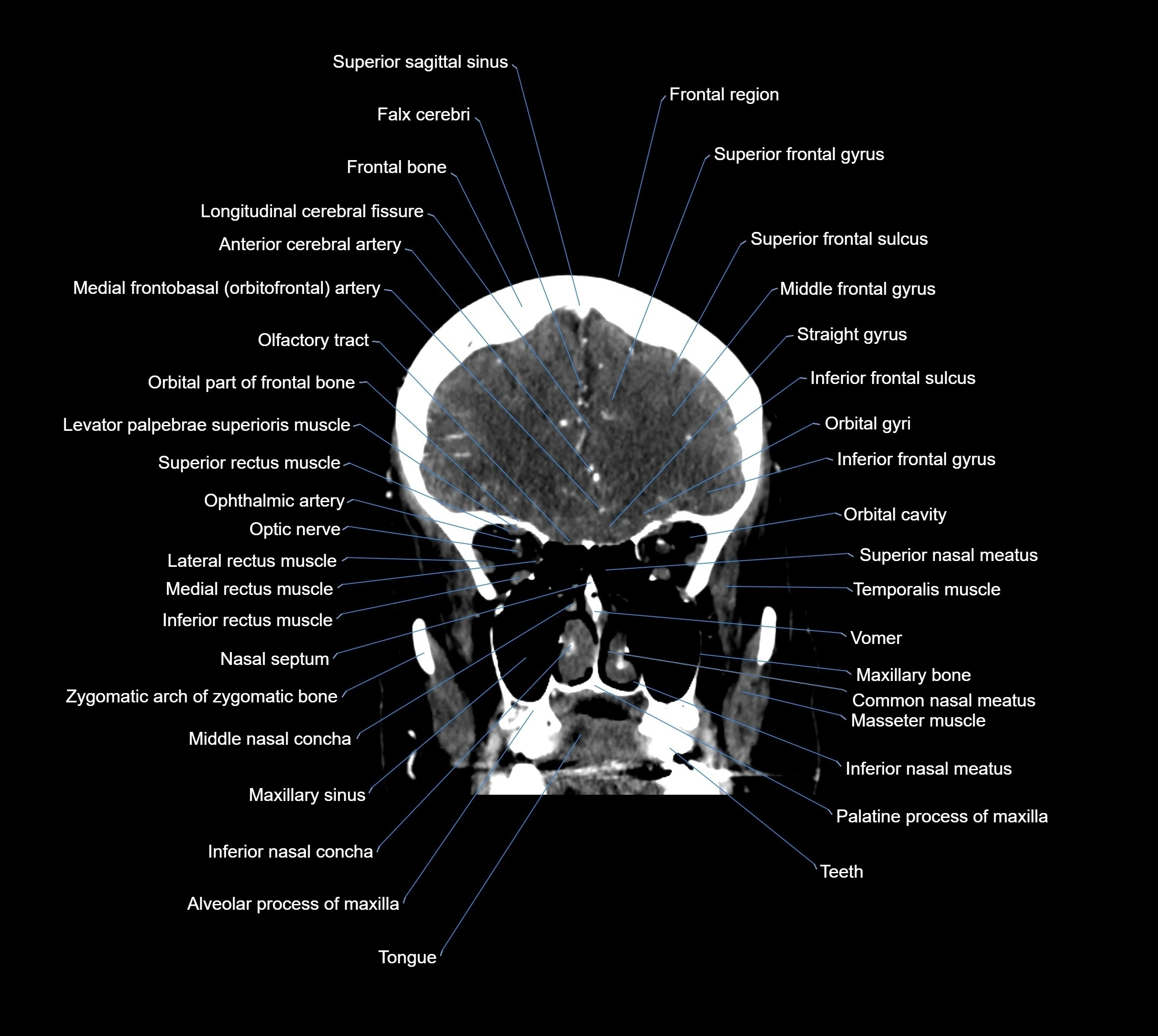 CT Brain coronal cross sectional radiology anatomy image  -img-00001-014.webp